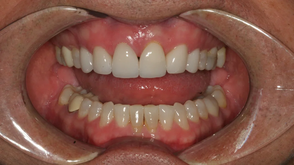 Before dental treatment at Metropolitan Dental Centre, case 19