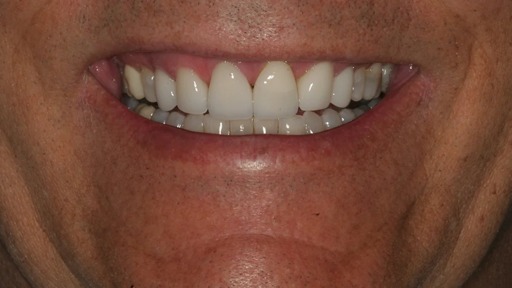 Before — Metropolitan Dental Centre case 19