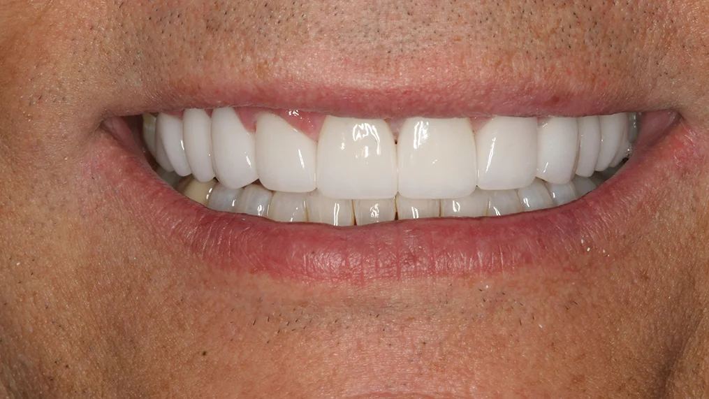 After — Metropolitan Dental Centre case 19